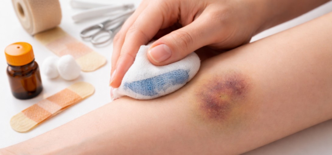 Μελανιές: Γιατί εμφανίζονται και πώς φεύγουν πιο γρήγορα