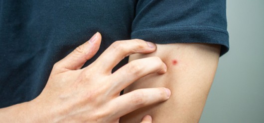 Κοριοί: 5+1 tips για να απαλλαγείτε άμεσα από το “δύσκολο εχθρό” - Featured Image
