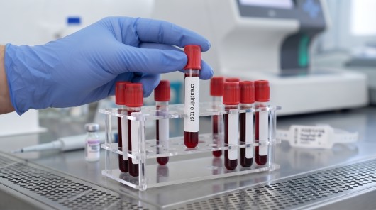 Creatinine: What it is, normal values ​​and which foods to avoid...