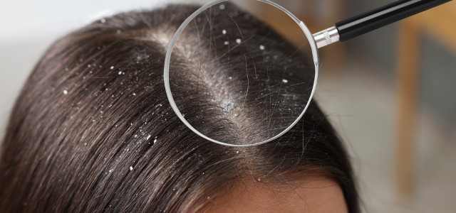 Πιτυρίδα: Ποια είναι τα είδη της και πώς τα ξεχωρίζουμε